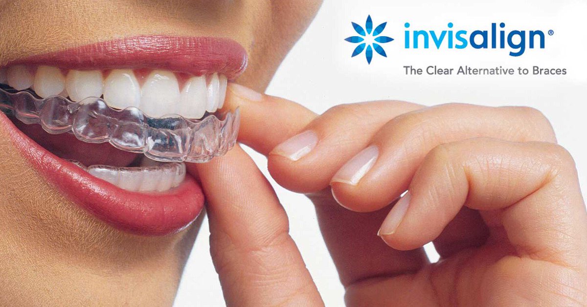 DENTALGROUPbd's tweet photo. #Invisalign endereza los dientes mediante #Placas 
Calle 119 # 7-14  Cons 707 tel:6121508 
https://t.co/ykvPrEf5iZ https://t.co/NwoqplVYiN