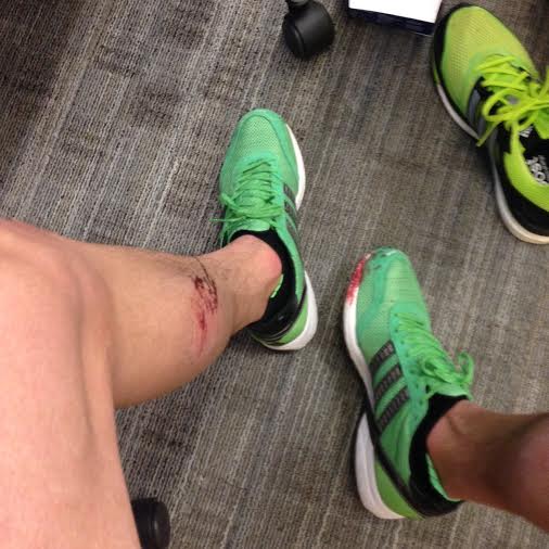 IanBooorrell's tweet photo. Poor showing at #UnitedNYCHalf. Added slight injury to insult. Special thanks to @NYCUSTOMPT. On to @bostonmarathon https://t.co/THtHnHlC6l