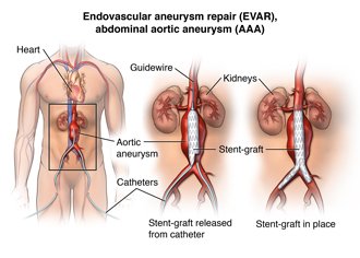 RsJantung's tweet photo. Thorac endo vascular aortic repair (TEVAR)  dn endo vascular aortic repair (EVAR). Terapi mengatasi aorta membengkak https://t.co/ojRrzYQYtv