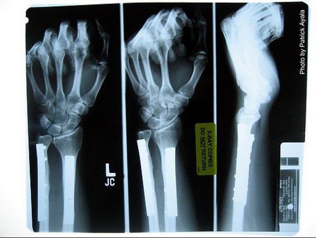 Как называется разрушение костей. Профессиональные деструкции. Как называется разрушение костей. Заболевание костей и суставов название. Болезнь при которой разрушаются кости.