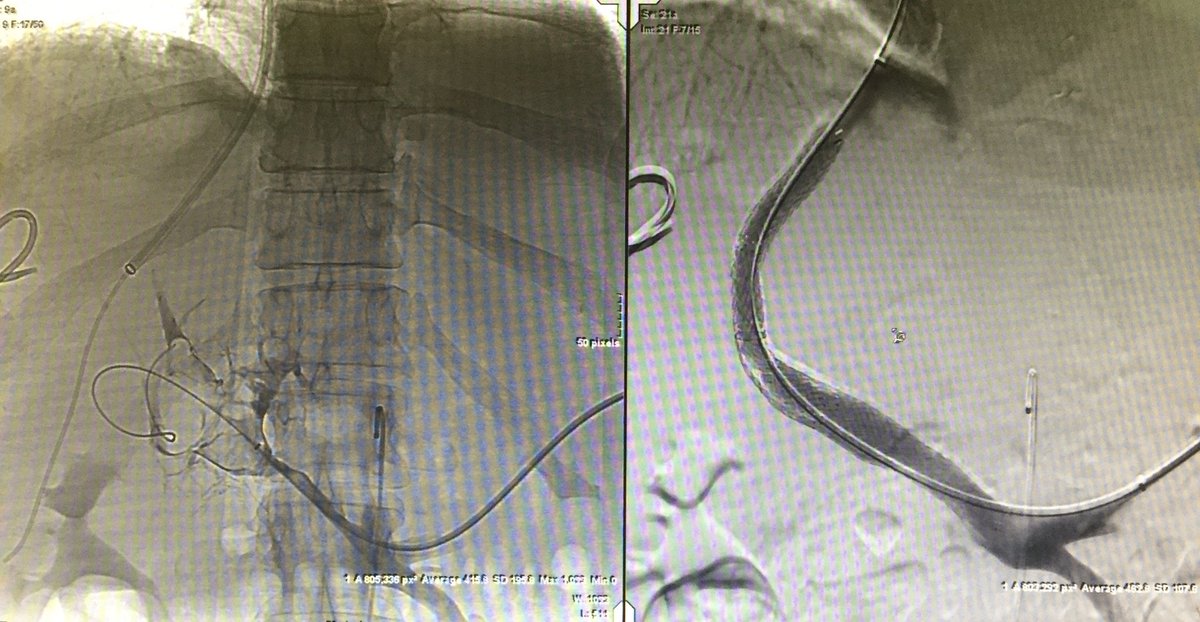 MountSinaiIR's tweet photo. Live @MountSinaiNYC #IRad: Good ol fashioned #Transplenic TIPS #PVT @rkryu @MUSCVIR @gsiskin @Drshiloh @roblookstein https://t.co/fkbk6G16DO