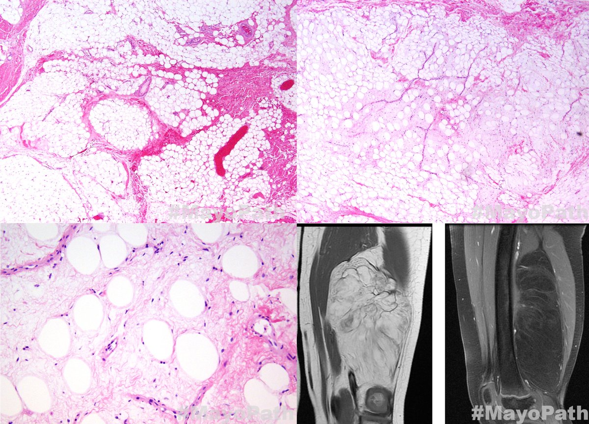 kabeerkshah's tweet photo. Left Thigh Mass | Guess the age? | #MayoRadPath #MayoPath #BSTpath @mayocliniclabs @JMGardnerMD https://t.co/OHGDR15bdc