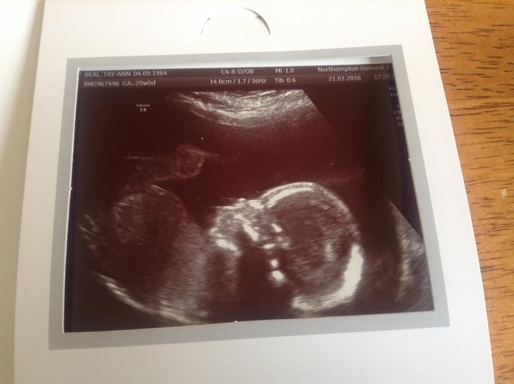 sargered23's tweet photo. Had our 2nd scan today and happy to announce that we are having a baby girl so this is Lola Brooke Sargeant https://t.co/wKrcn8MrV0