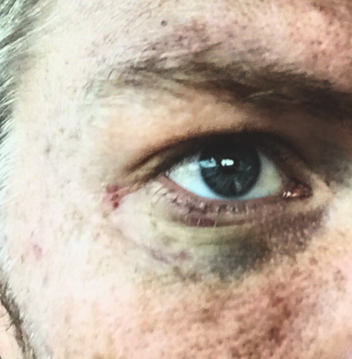 Playing a little bit of hard ball #footy head is always over the ball comes out with a black eye welcome to footy