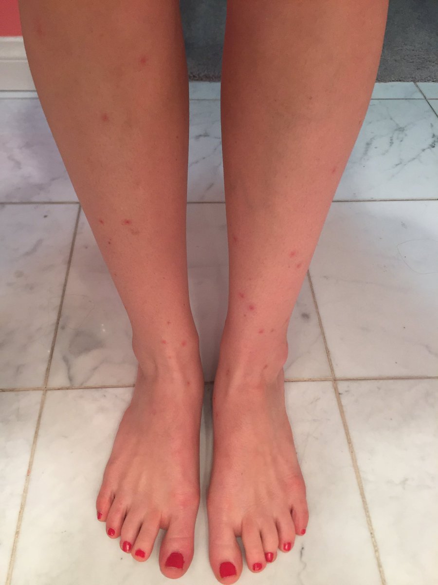 DAppletree's tweet photo. The Thai mosquitoes lovingly referred to me as 'Sugar Legs' #fml #bitesonbites https://t.co/1esRJoMGGZ