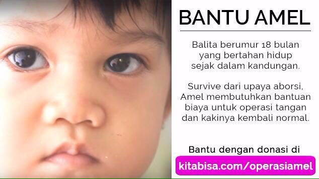 JennyJusuf's tweet image. Kenalkan, Amel, 18bulan. Pejuang cilik yg lolos dr aborsi. Bantu biaya operasi Amel, yuk :') kitabisa.com/operasiamel