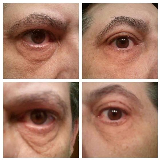 neriumjulie's tweet photo. También los hombres quieren verse más jóvenes y están usando #Nerium, y miren los resultados. Inf. 55.1900.5779 https://t.co/ahnHMVnQqF