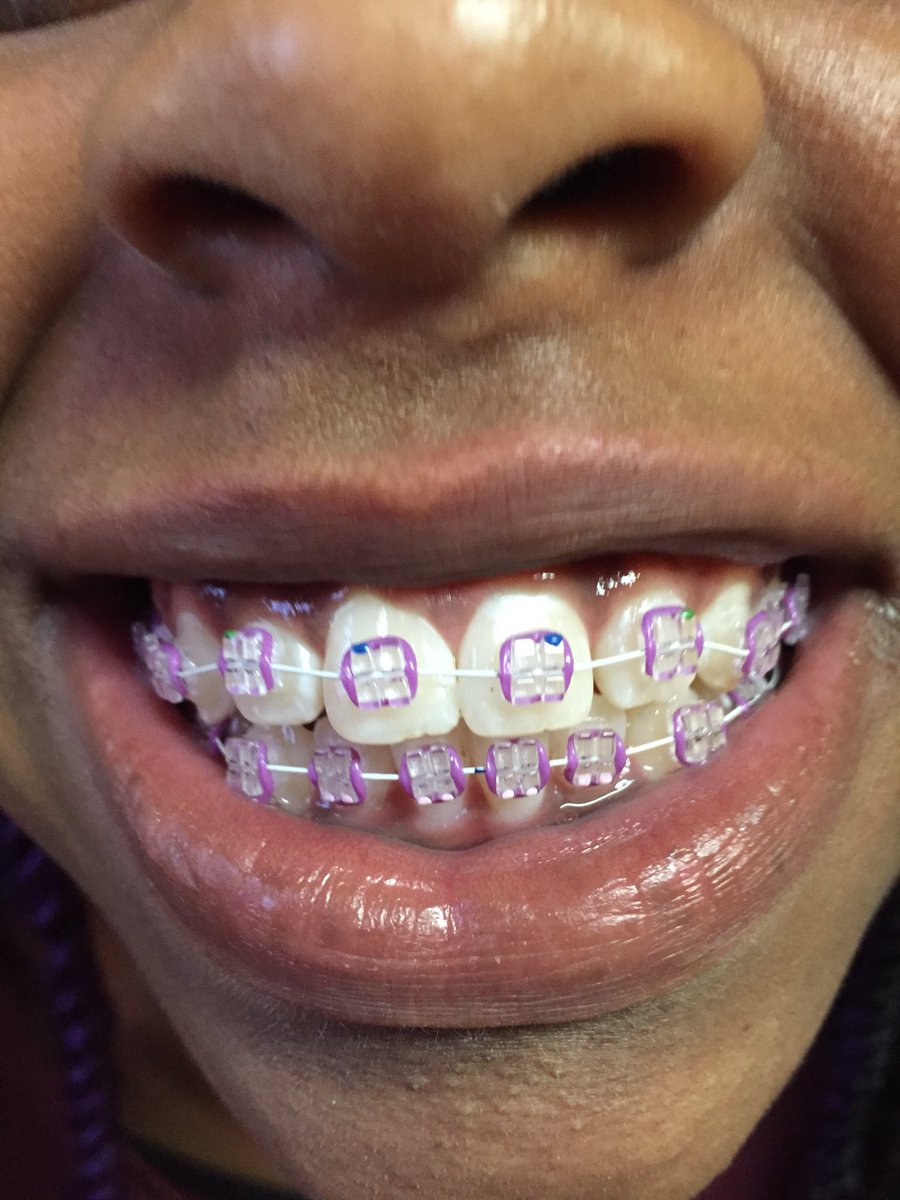 Clear braces