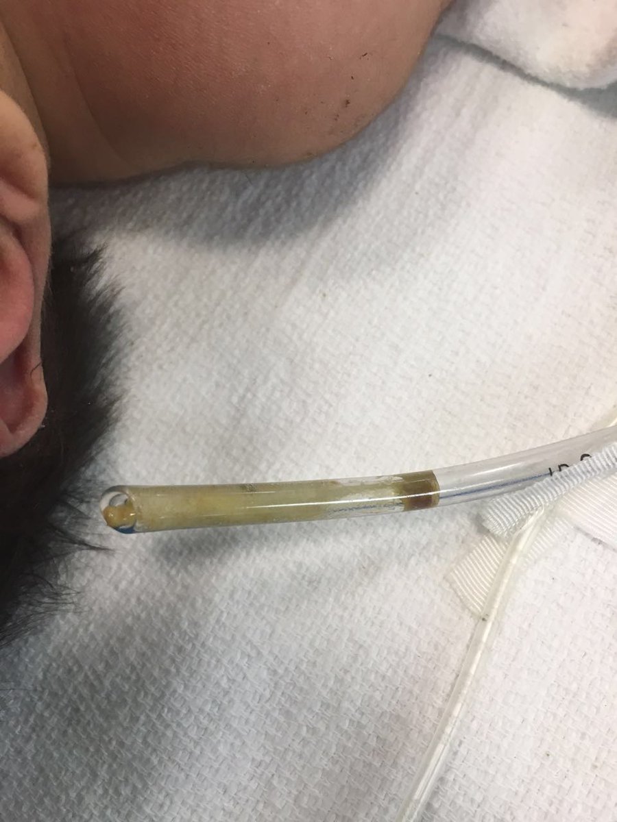 MediCasos's tweet photo. RT @PhilPage27: Por eso es importante aspirar secreciones. RN con SAM, de pronto SO2 20% actual SO2 95 sin tubo https://t.co/fzGwBseUbq
