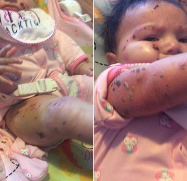 CBCAlerts's tweet photo. Preliminary findings say #Kashechewan First Nation kids suffering from scabies, mild impetigo, eczema. 1/2 https://t.co/4eIMToA00t