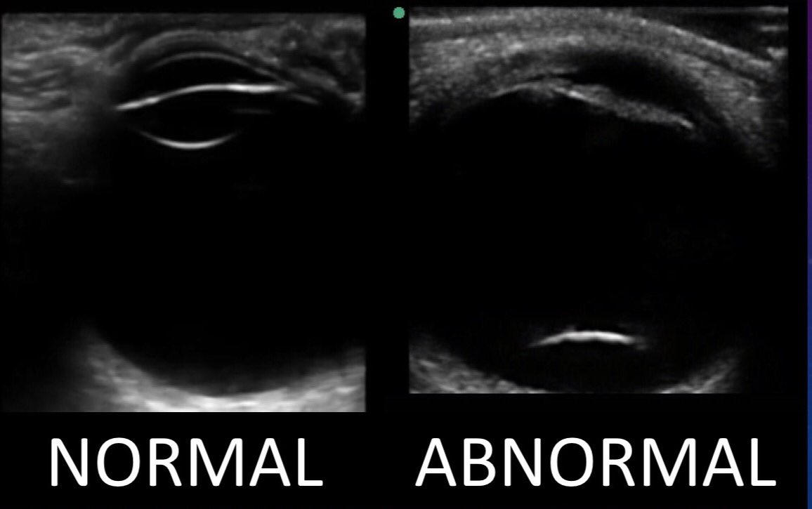 VenkBellamkonda's tweet photo. Did your patient misplace their lens? Find it with #POCUS! #lensdislocation @MayoClinicEM #FOAMus #FOAMed https://t.co/5YXNMfP8sU