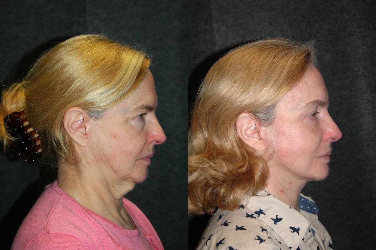 DrJacono's tweet photo. My patient looks 20 yrs young after #deepplane #facelift, #eyelift, #laserresurfacing https://t.co/uMwtF7VAXK https://t.co/Be9GNtxreo