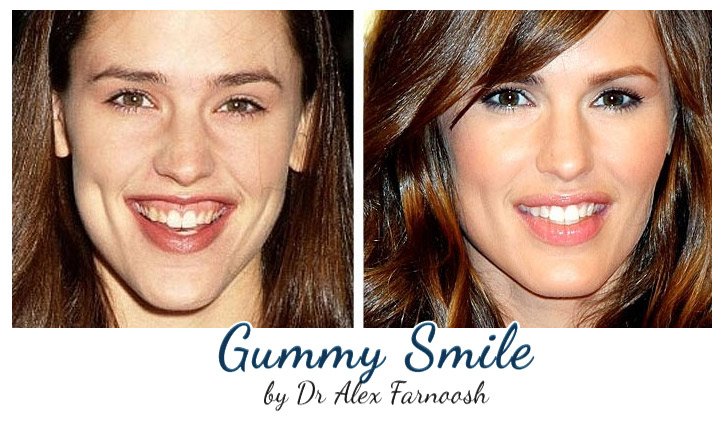 Celebrity Gummy Smile