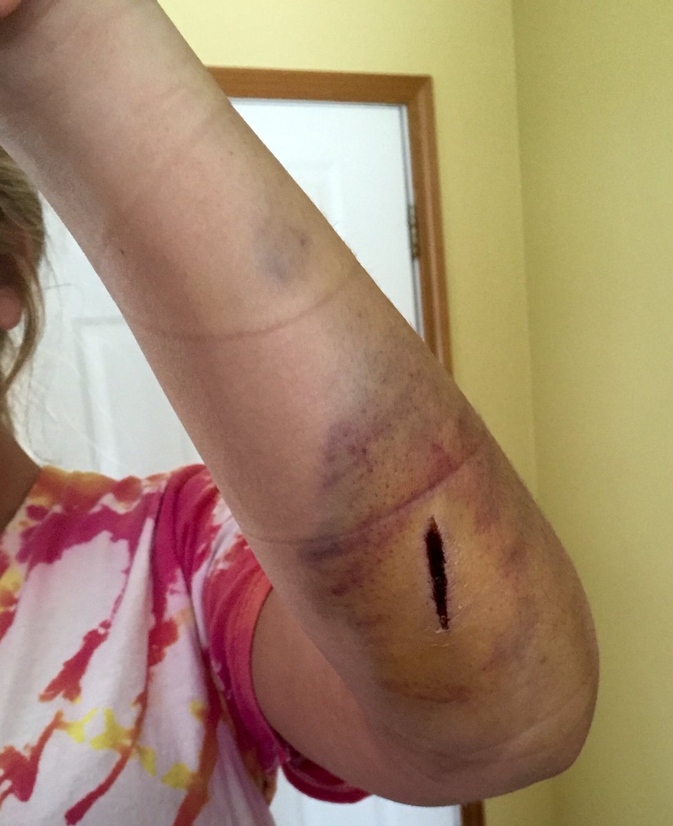 Kelli_Fridsma's tweet photo. Happy 1 year w/o falling down the stairs🎉 #GoKel https://t.co/uVD2gcxDP6
