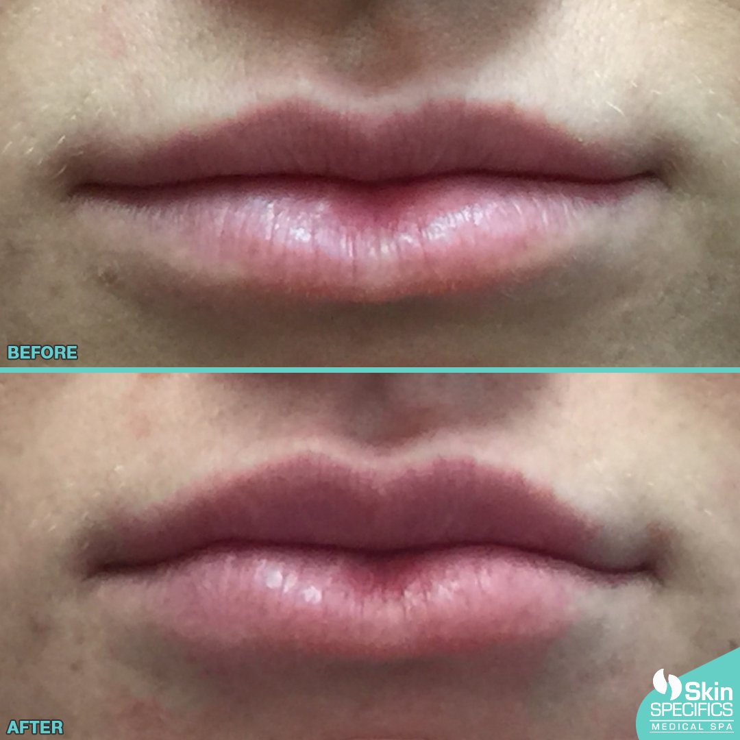 SkinSpecifics's tweet photo. Lip correction - lip enhancement
#juvederm #botox #lips #lipcorrection #lipenhancement https://t.co/E3bOOH1rgD