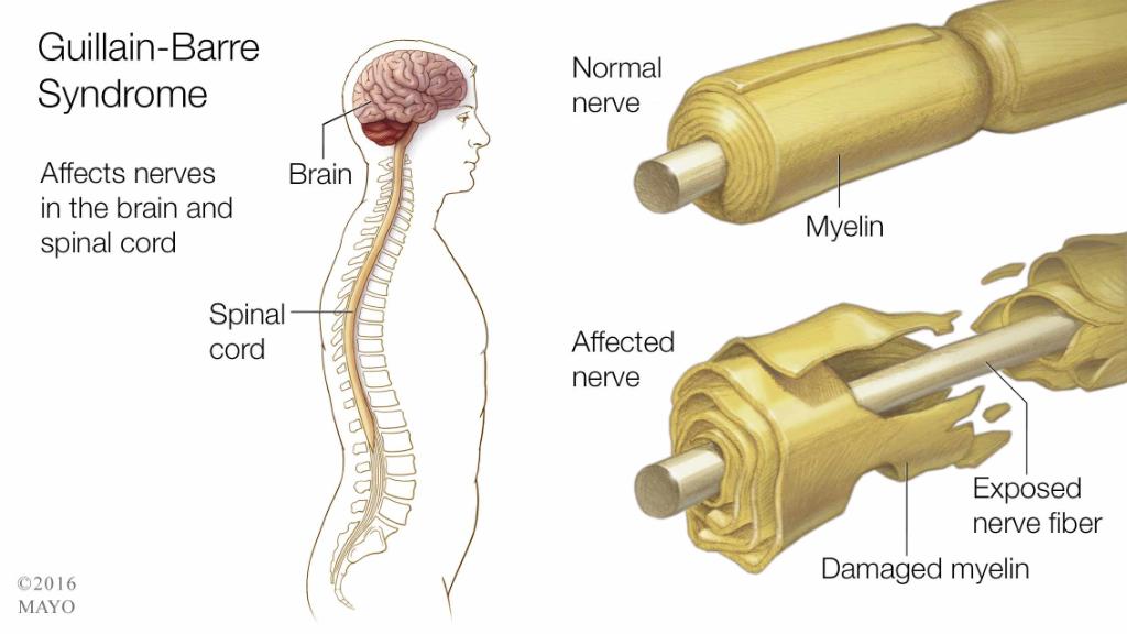 MayoClinic's tweet photo. Guillain-Barre Syndrome and #Zika virus: Is there a connection? https://t.co/aHiq0sg9vu https://t.co/HdqiikSEsv