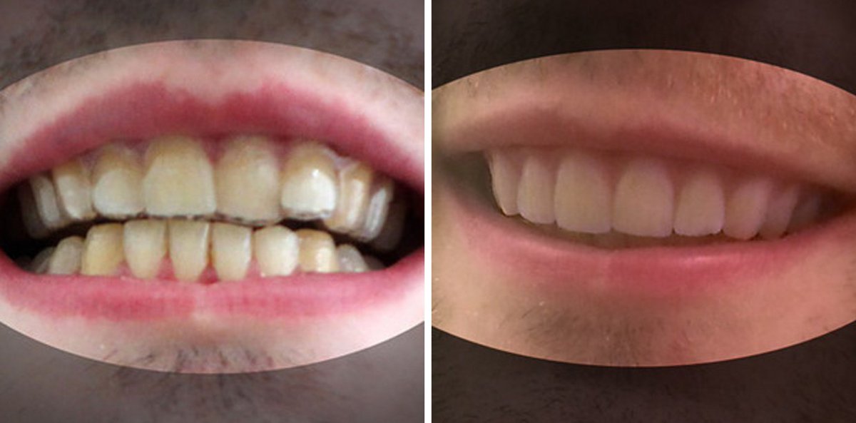 3Tectonix's tweet image. #3dprinting Recovers the #Smile of a Student
3dtectonix.com/3D-Printing-Re…
#3dprinted #3dprint #orthodontics #3dtectonix