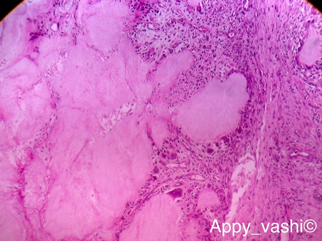 DrAppyNI's tweet photo. Gouty arthritis. #hour #bone #pathology #pathresident #mskpath https://t.co/90xhYPfDbN