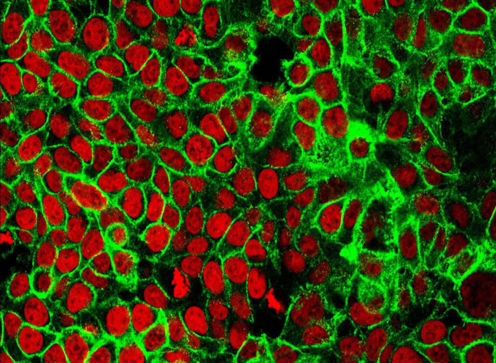 DanaFarber's tweet image. Exploring the possibility of using #immunotherapy to treat colorectal cancer. bit.ly/1XHanEV #crcsm