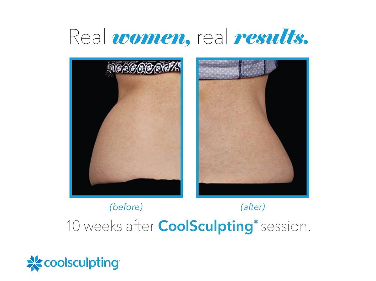 HayesEsthetics's tweet photo. #CoolSculpting works -- come in and see for yourself! #fatloss https://t.co/QENpfx5iVV