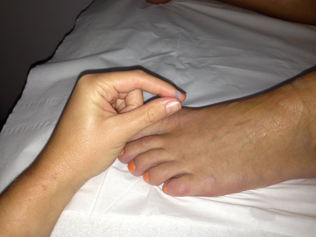 rivendalephysio's tweet photo. Acupuncture clinics available at @Winners2000Pgn Great improvement in pain and wellbeing. Get in touch to book https://t.co/KMplGNU7jO