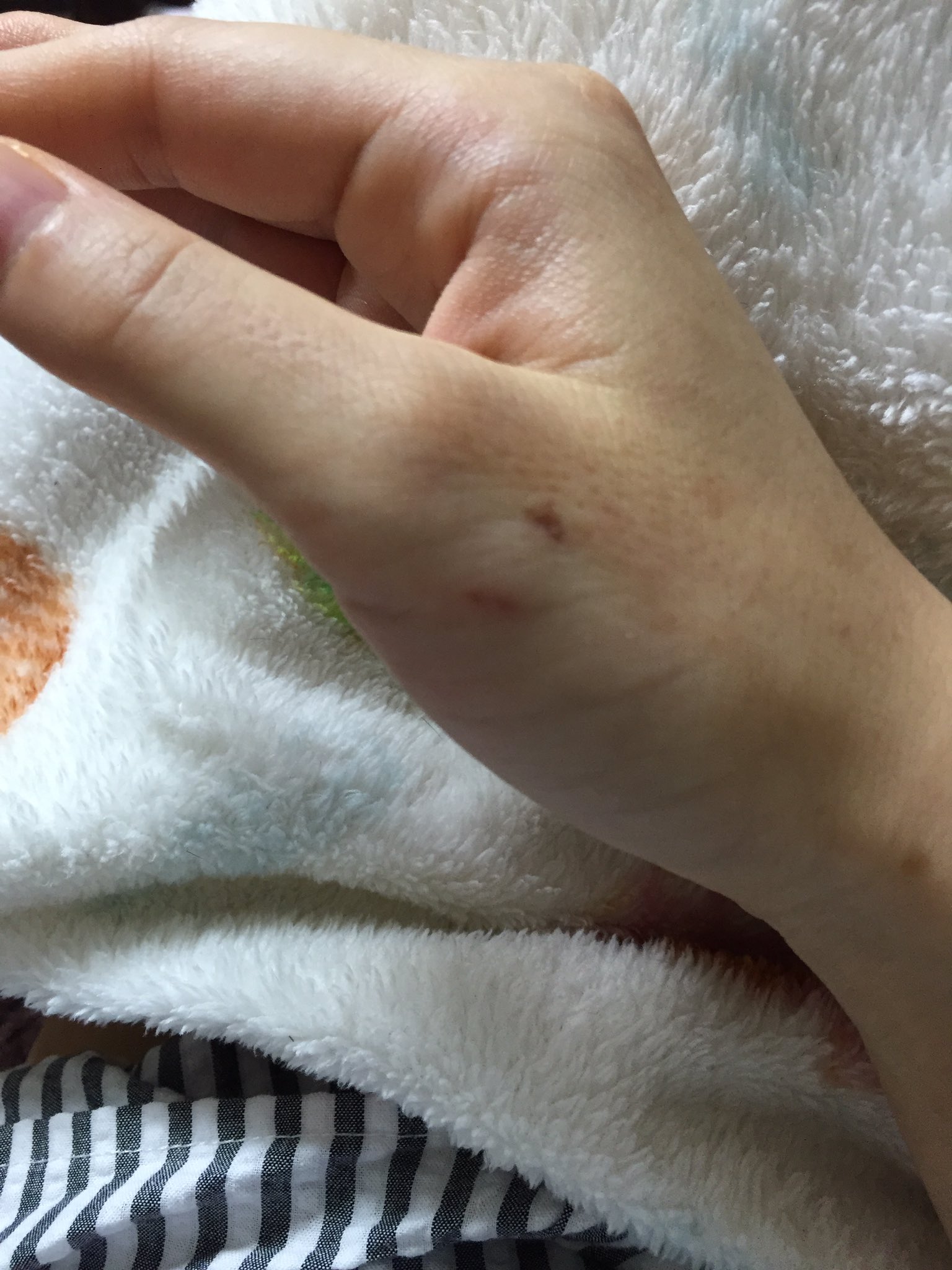 美月 陸亀 デグー デグー飼いさんに知っておいてほしい事 デグーに噛まれて 10日目 たったこれだけの傷なのに私の右手は全く動きません デグーは基本的に狂犬病やトキソプラズマのような菌は持ってないとされていますが口腔内はどんな動物でも雑菌