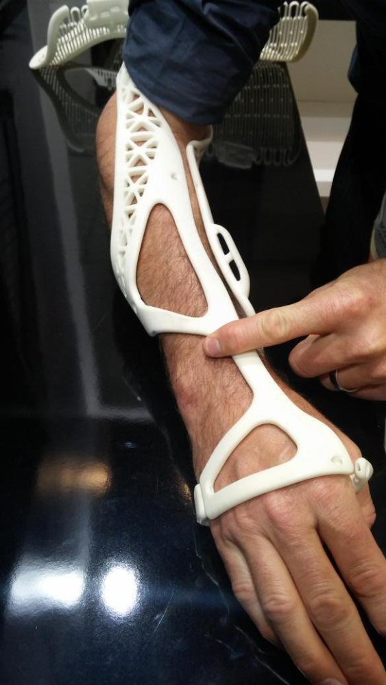 Berci's tweet photo. The first patient to ever have a shower with a 3D printed cast on a broken arm. #3dprinting #digitalhealth https://t.co/ozo8weNReB