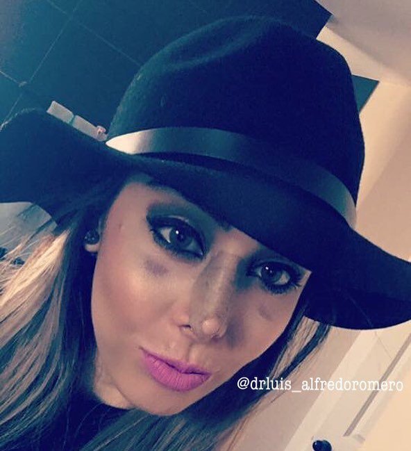AACabobyBea's tweet photo. #rhinoplasty #FacialSurgery #Presumetuparche #RinofastJuarez #Rinofast #Loscabos #CdJuarez #LosCabosFacialSurgery #… https://t.co/kAz88Z9hft