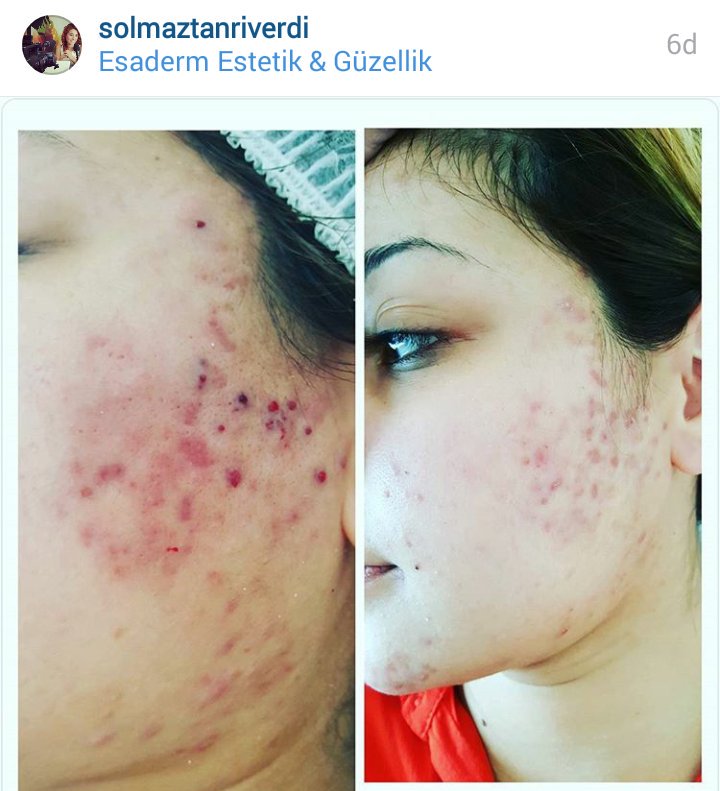 AramisDermapen's tweet photo. #dermapen
#microneedling
#dermapen3
#rejuvenate
https://t.co/Hv2W7o2I6i https://t.co/5rkVSZ11GF