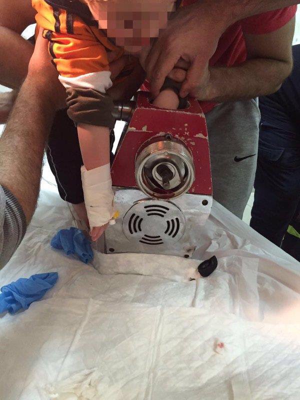 حالة حرجة با#الطايف
نصيحه الى الاباء والامهات انتبهو لاطفالكم فانتم مسئولين عنهم يوم القيامه 
الله سلم يده من البتر