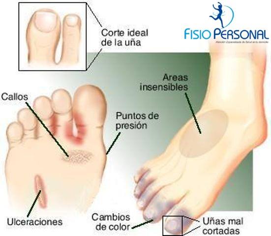 polineuropatía diabética síntomas