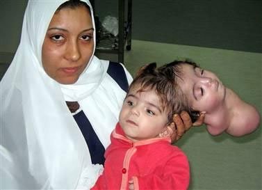 Know's tweet photo. A baby was born in 2005 with a conjoined head that had no body. The head could blink and smile. https://t.co/MYU8H2zMPW