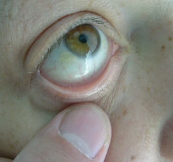 Pale Conjunctiva