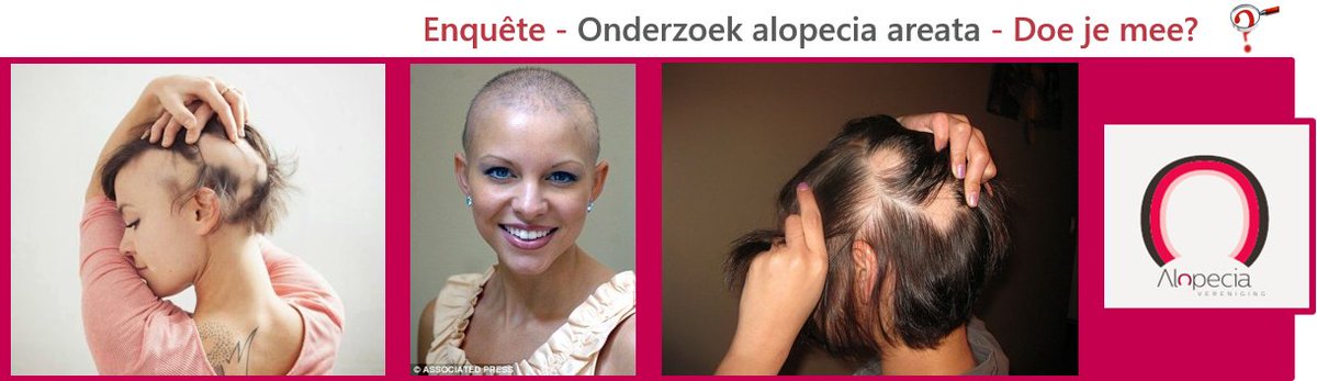 AlopeciaVerenig's tweet photo. Onderzoek #alopecia. In samenwerking met hogeschool Utrecht. Doe mee&amp; vul de enquête in! https://t.co/YvvrtsxRw1 RT! https://t.co/X3ZEJRKKtM