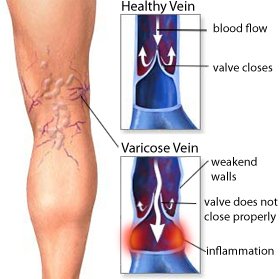 mchristov1's tweet photo. Home Remedies for Varicose Veins
https://t.co/0GGf73YuYQ https://t.co/IdNrvdTit2