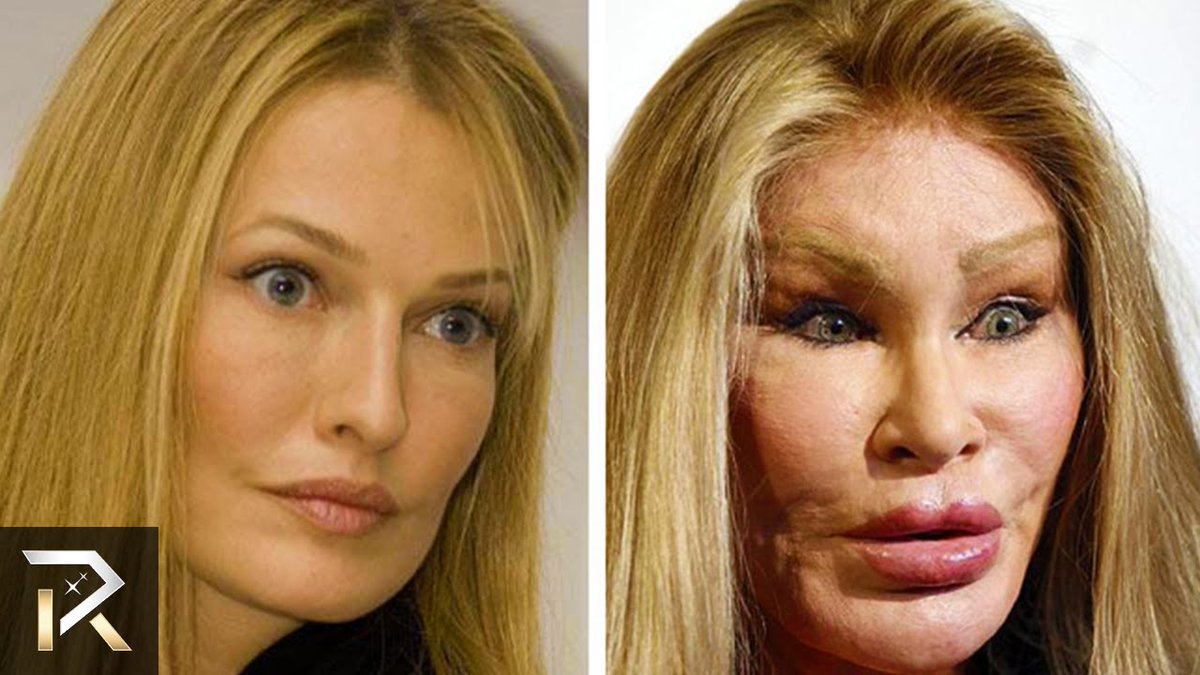 Worst Cases Of Plastic Surgery Obsession - http://mustsee100.com/worst-case...