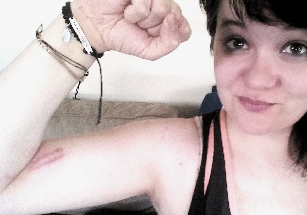 Callyndorval's tweet image. Aw, thanks for the pretty bruise Frank! @Bloodandironwma #HEMAlove #singlestick