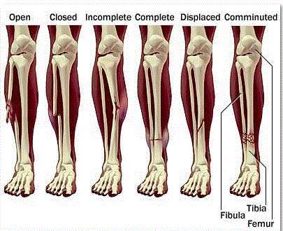 medictests's tweet photo. GREAT image of common fractures for visual learners! https://t.co/YUqwY7u5mS