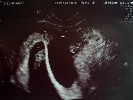 CSOJoanne's tweet photo. HUGE congrats to Surro A &amp; IFs on finding out they are they are expecting TWO bundles of joy!!  #CanadianSurrogacy https://t.co/QzCeX8nx7y