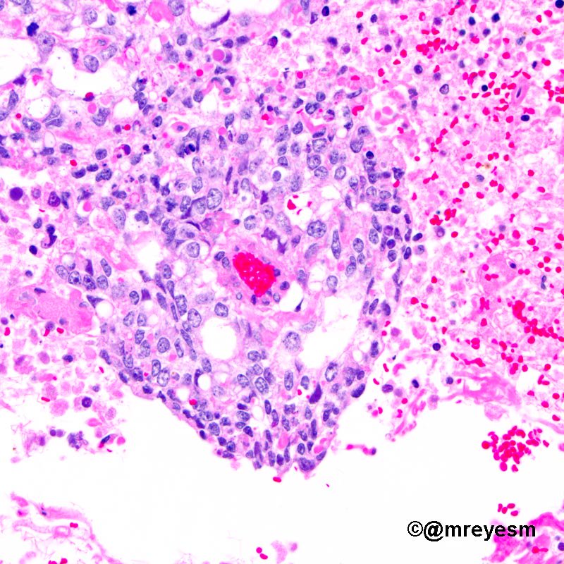 mreyesm's tweet photo. #pathology #pedipath 16 YOF, 2,886 g mixed germ cell tumor. Shiller-Duval bodies with α-fetoprotein globules in YST https://t.co/dfrtzeyMJm