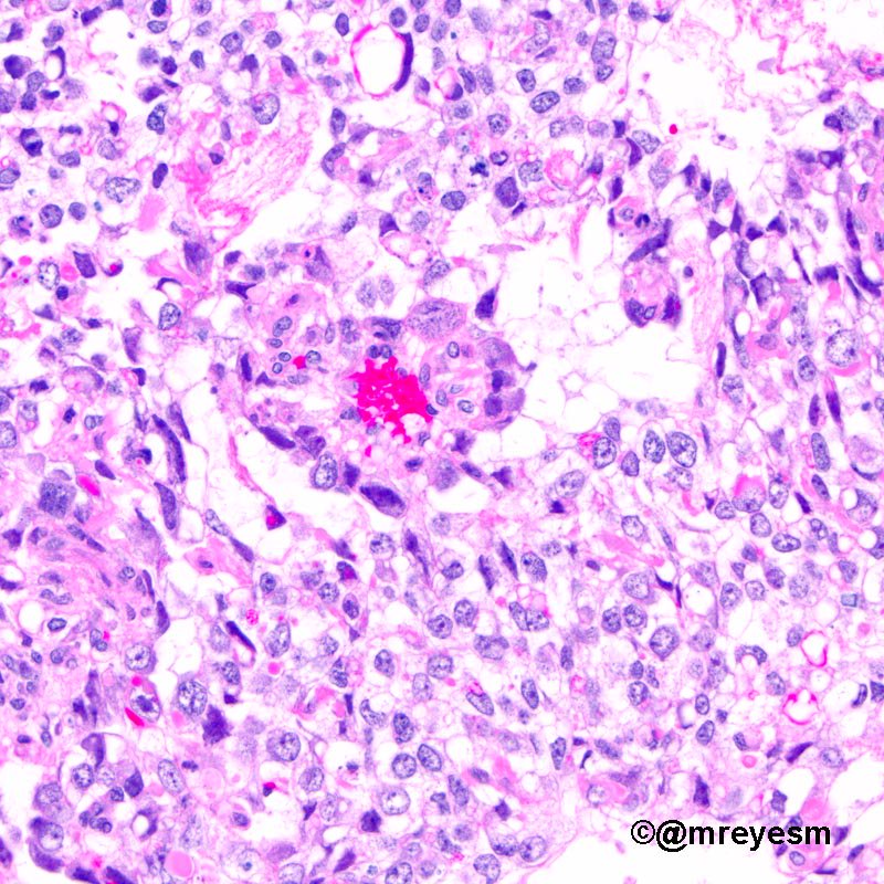 mreyesm's tweet photo. #pathology #pedipath 16 YOF, 2,886 g mixed germ cell tumor. Shiller-Duval bodies with α-fetoprotein globules in YST https://t.co/dfrtzeyMJm