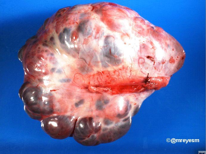 mreyesm's tweet photo. #pathology #pedipath 16 YOF, 2,886 g mixed germ cell tumor. Shiller-Duval bodies with α-fetoprotein globules in YST https://t.co/dfrtzeyMJm