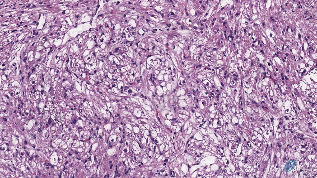 RyanneMDMBA's tweet photo. nasal PEComa: HMB45, Melan A, SMA positive  #pathology #ENTpath #BSTpath https://t.co/m79B4is0oc