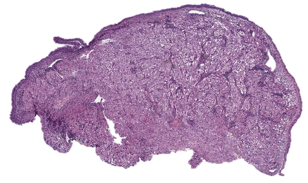 RyanneMDMBA's tweet photo. nasal PEComa: HMB45, Melan A, SMA positive  #pathology #ENTpath #BSTpath https://t.co/m79B4is0oc