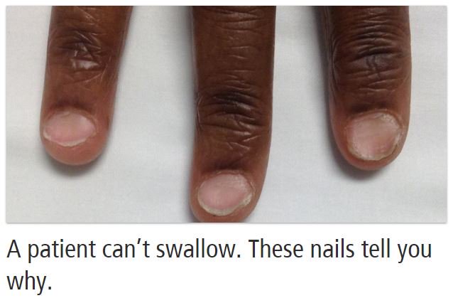 StanfordMed25's tweet photo. These fingernails hold an important clue to the patient's condition. Details: https://t.co/z0xE7JLG1a #meded https://t.co/oYrRvH92a1
