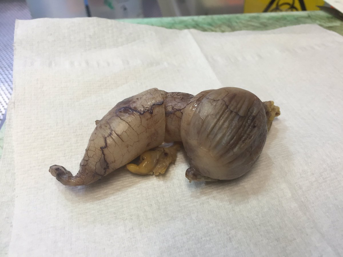 robdgol's tweet photo. Good example of an appendiceal mucocoele on the cut-up bench this afternoon. #pathology https://t.co/hJl6FPt4z8