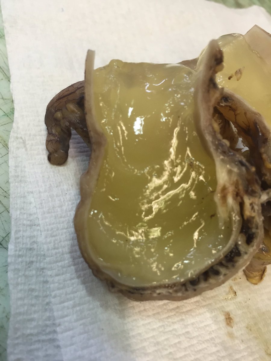 robdgol's tweet photo. Good example of an appendiceal mucocoele on the cut-up bench this afternoon. #pathology https://t.co/hJl6FPt4z8