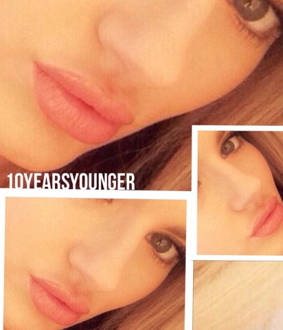 Lips by <a href="/10yearsyoungerr/">10 YEARS YOUNGER</a> All lips sent to us by our own clients # lip fillers #cheekenhancement #botox #manchester