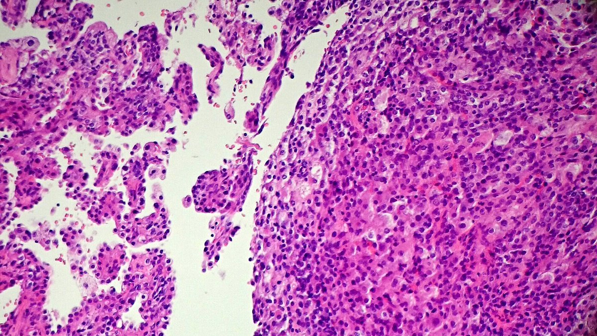 a_sleeping_dog's tweet photo. Sclerosing hemangioma, lung. https://t.co/PWGN32A7ZQ