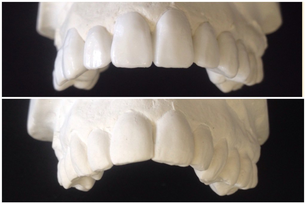 DSDdentallab's tweet photo. Nice 5-5 wax up! #before #after #wax #teeth #hi-techwax #dentistry #dental #dsddental https://t.co/6bX2yoPZDh